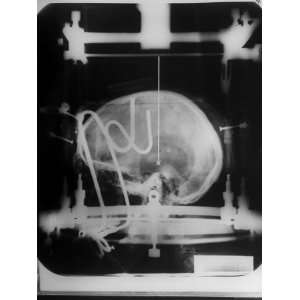  X Ray Picture of Patients Skull in Metal Frame with Path 