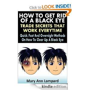 How To Get Rid Of A Black Eye  Trade Secrets That Work Everytime 