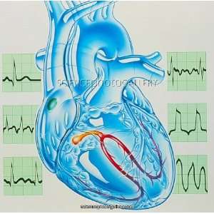 Artwork of cardiac arrhythmia with heart andamp;amp; ECGs Photographic 