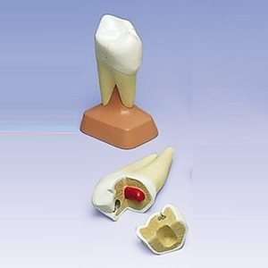  Upper Twin Root Molar with Cavities , 2 part Health 