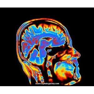  Coloured CT scan of the brain in head (side view) Framed 